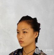 脂肪填充1一20天恢复图真人术后反馈，变化不止一点点！