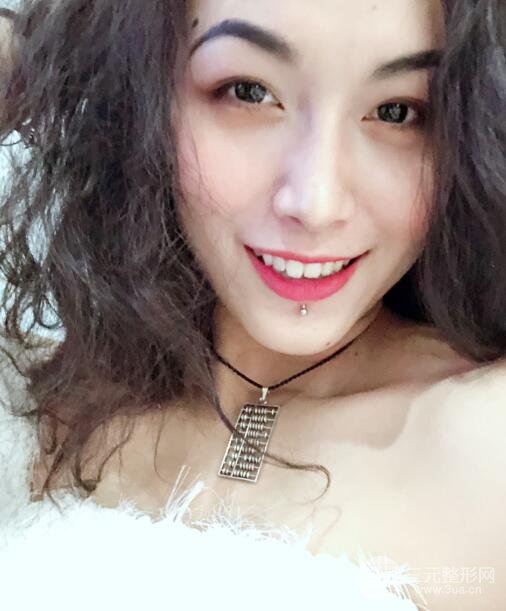 脂肪填充的第一天
