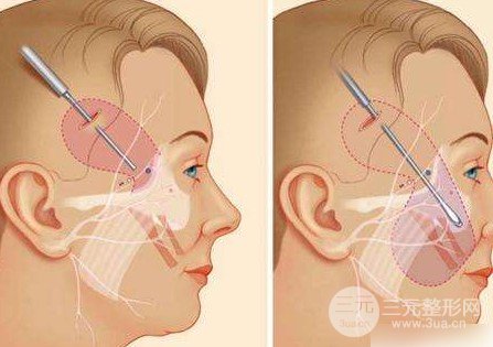 小切口除皱术的危害
