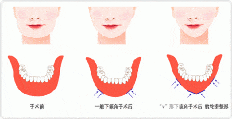 削骨瘦脸手术多少钱