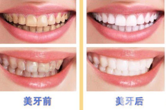 烤瓷牙的寿命是几年