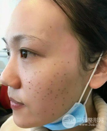 彩光去雀斑会结痂吗