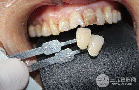 一般烤瓷牙价格多少