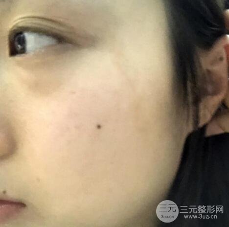 疤痕去除案例