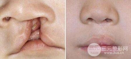 兔唇修复后图片