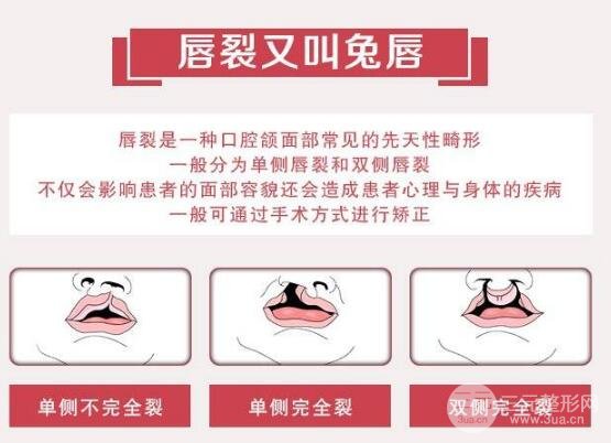 兔唇修复后图片