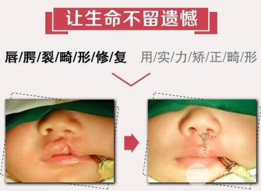 兔唇修复后图片