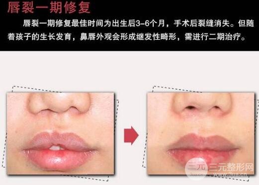兔唇修复后图片