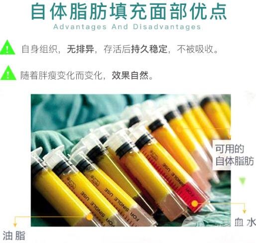 自体脂肪丰太阳穴