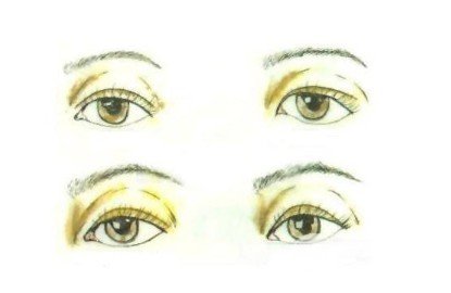 双眼皮全切过程