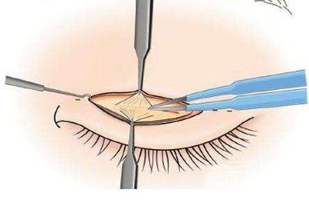 双眼皮全切过程