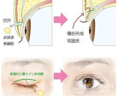 双眼皮全切过程
