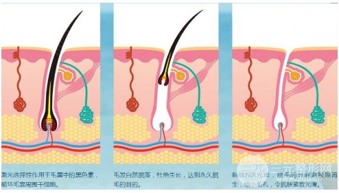 复合彩光脱毛和激光脱毛一样吗