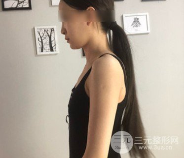 水滴型假体隆胸一年后