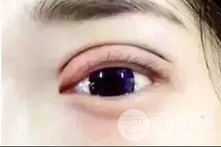 双眼皮过厚
