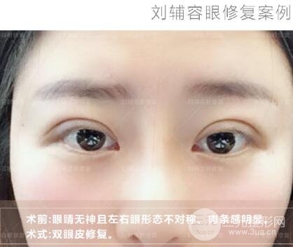 双眼皮大小不一