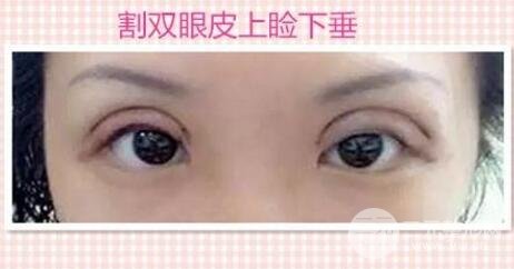 上眼睑下垂