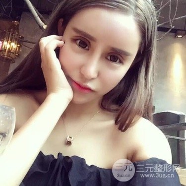 双眼皮过宽