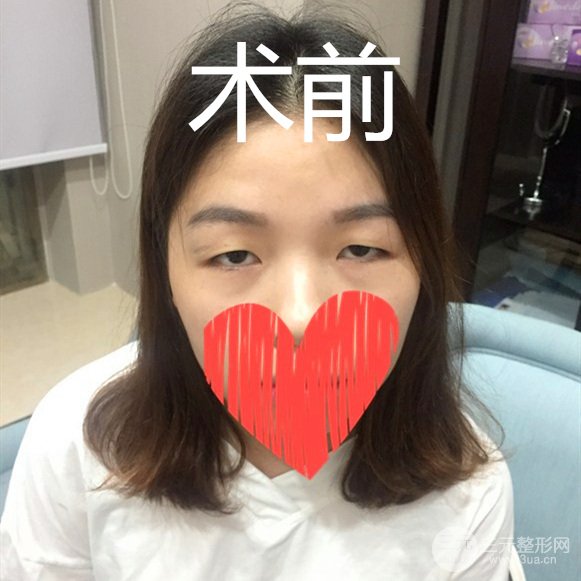 双眼皮过小