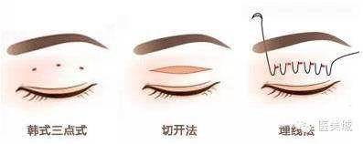 割双眼皮恢复多久