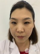 光子嫩肤前后对比照片真实记录，见证肌肤的蜕变！