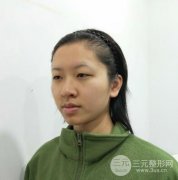 开内眼角恢复过程图真人记录，眼睛放大N倍！