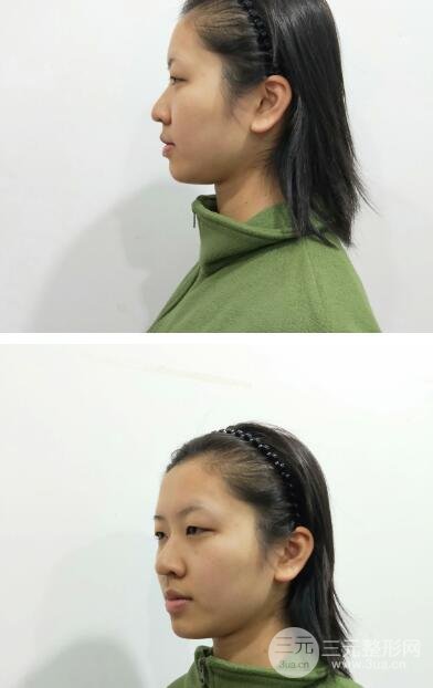 术后1-3天