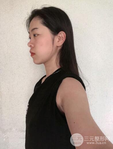 假体隆胸后恢复过程图真实记录，饱满胸部好吸睛！
