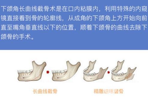 磨骨手术风险大么