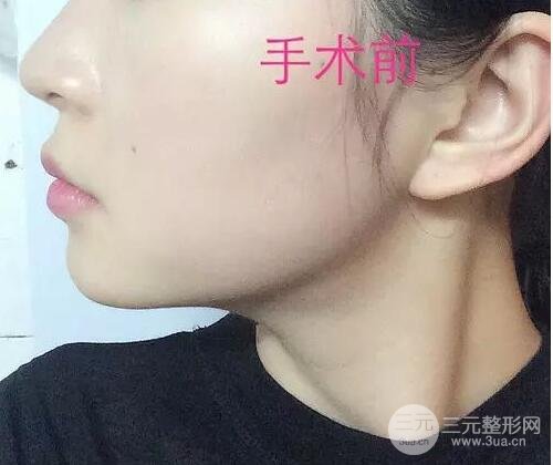 垫下巴前后对比果图发布，小V脸的精髓就在这里啦！