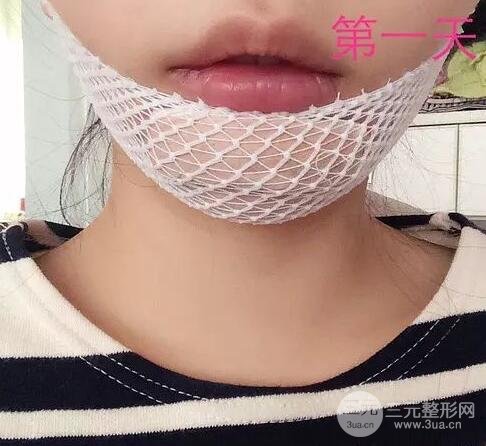 选择垫下巴