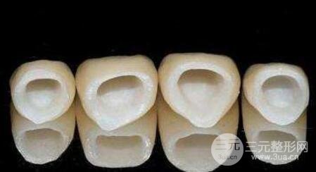 镍铬合金烤瓷牙