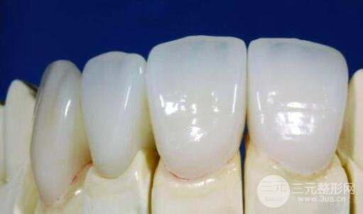 钯金合金烤瓷牙