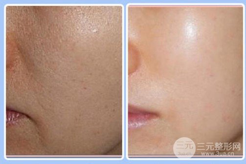 光子嫩肤和果酸换肤功