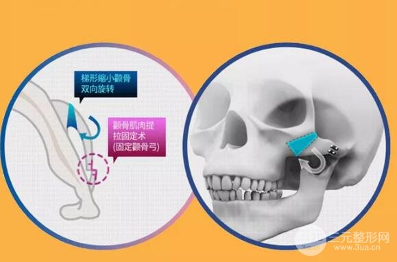 什么是磨颧骨手术?