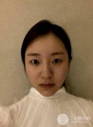 双眼皮恢复过程图披露，真人双眼皮手术案例展示！