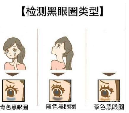 黑眼圈的类型