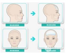 自体脂肪填充眉弓,额头大概需要多少钱? 自体脂肪填充眉弓,额头大概需要多少钱?