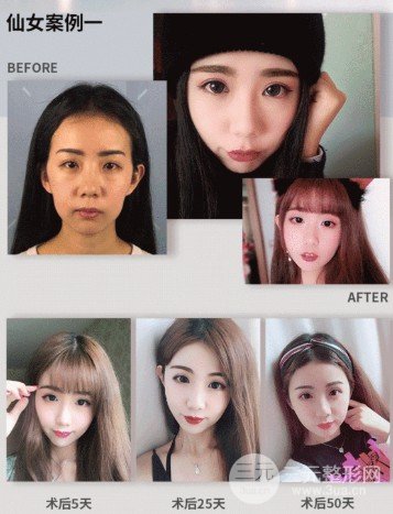 自体脂肪填充眉弓额头价格