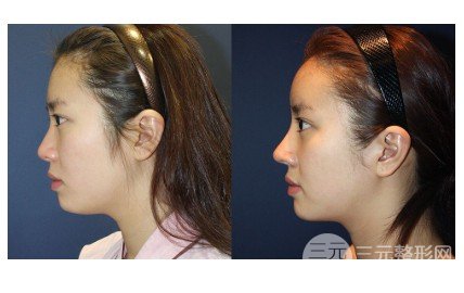 自体脂肪填充眉弓额头价格