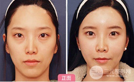 自体脂肪填充眉弓额头价格