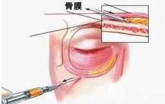 扒整形：自体脂肪填充泪沟降低吸收率的门道~