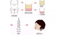 脂肪填充苹果肌两天后肿了,大概要多久才能消肿? 脂肪填充苹果肌两天后肿了,大概要多久才能消肿?