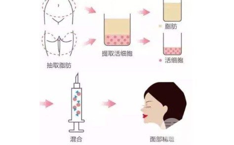 脂肪填充苹果肌两天后肿了