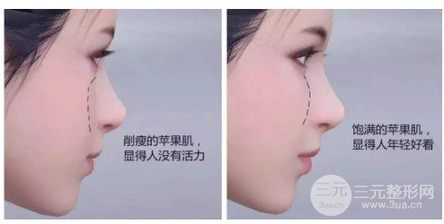 脂肪填充苹果肌两天后肿了