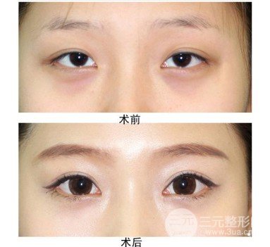 眼角开大整形手术