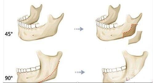 磨下颌骨要多少钱