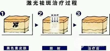 激光祛斑会反弹吗