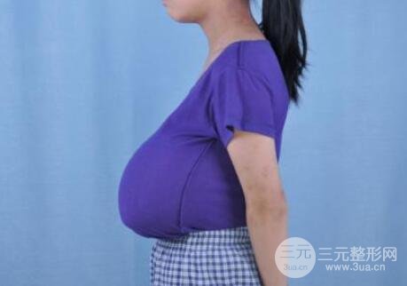 吸脂法缩胸过程