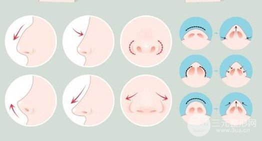 鼻翼整形要多少钱